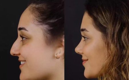 Breathe Better, Live Better with Septoplasty in Dubai