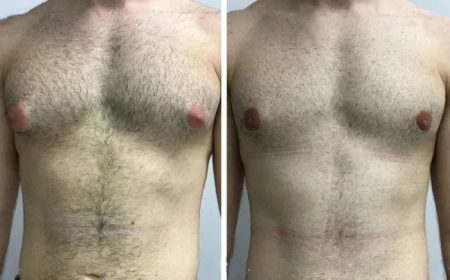 Interview with the Best Gynecomastia Surgeon in Dubai: What You Need to Know