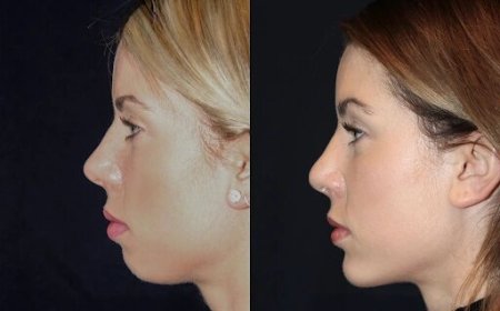 Chin Fillers in Dubai: How to Maintain Results