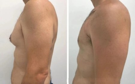 How to Ensure a Smooth Recovery After Gynecomastia in Dubai