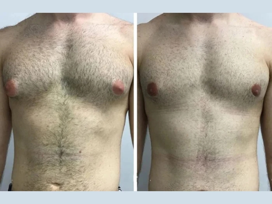 Interview with the Best Gynecomastia Surgeon in Dubai: What You Need to Know