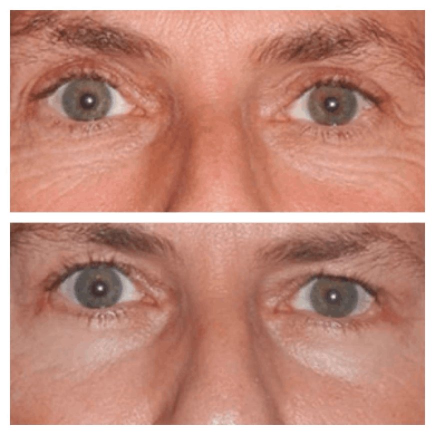Minimally Invasive Techniques Used by the Best Eye Bag Removal Surgeon in Dubai