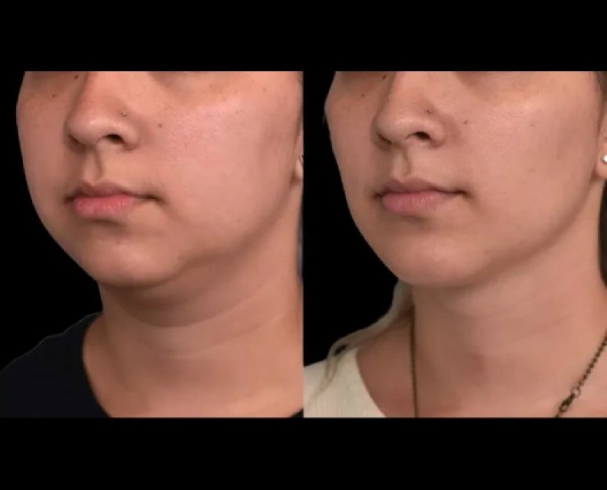 How to Know If Double Chin Removal Surgery Is Right for You, According to the Best Double Chin Removal Surgeon in Dubai