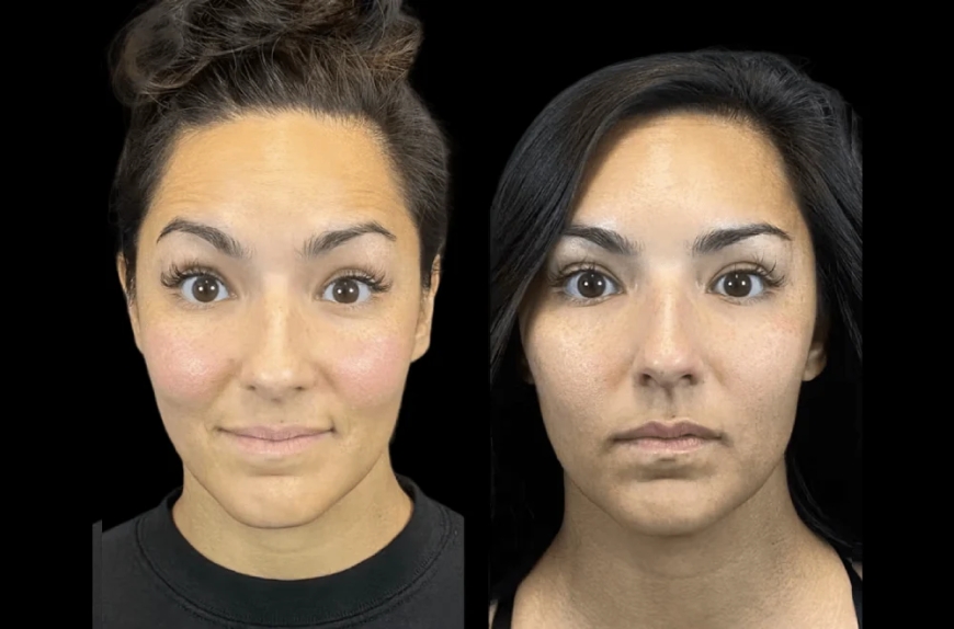 The Truth About Botox: Insights from the Best Doctors in Dubai