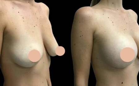 How the Best Breast Augmentation Surgeons in Dubai Support You from Consultation to Recovery