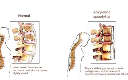 History of Lower Back Pain Relief (Lumbar Pain)