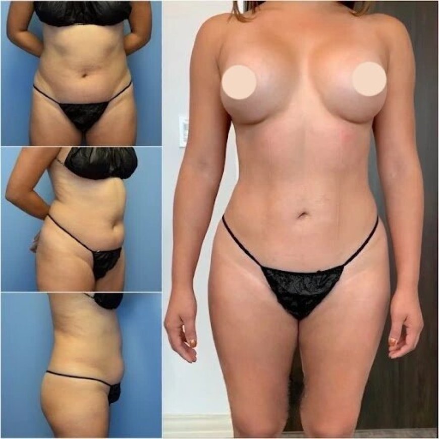 Sculpt Your Best Body with the Best Doctors in Dubai for Body Contouring
