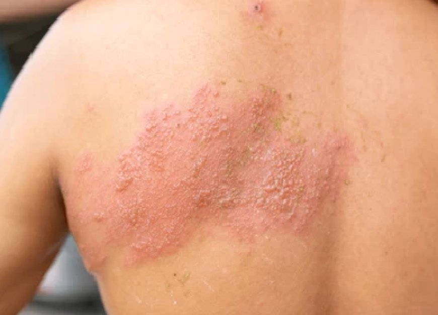 Understanding the Benefits of Ivermectin 3mg for Humans